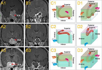 Outcomes and Complications of Aggressive Resection Strategy for Pituitary Adenomas in Knosp Grade 4 With Transsphenoidal Endoscopy